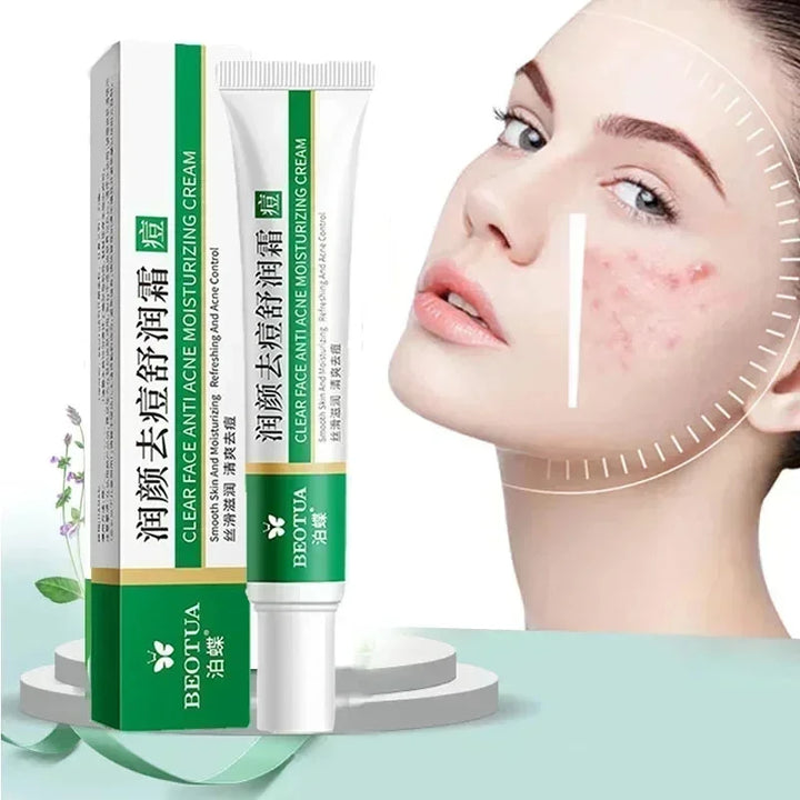 Herbal Acne Treatment Cream – Scar & Pore Remover, Oil Control & Whitening
